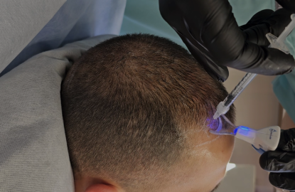 Mesoterapia Capilar