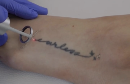 Remoción de tatuajes láser ND-YAG Q-Switched